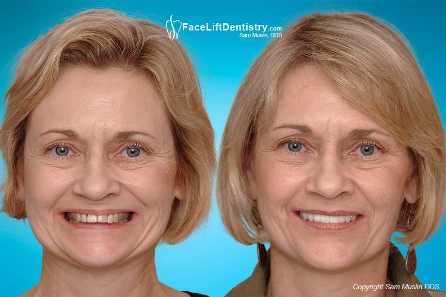 Face Lift Dentistry